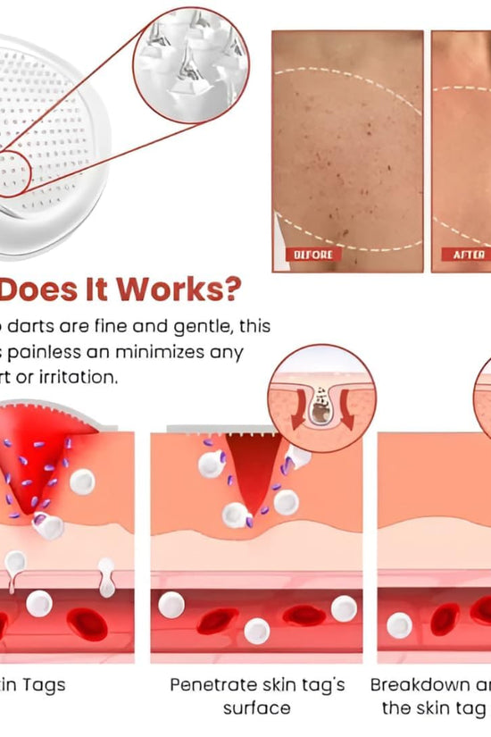 Skin Tag Remover Patch  (72 Patches)