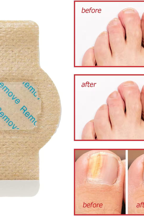 Nighttime Renewal Fungal Nail Patches (Pack of 21)