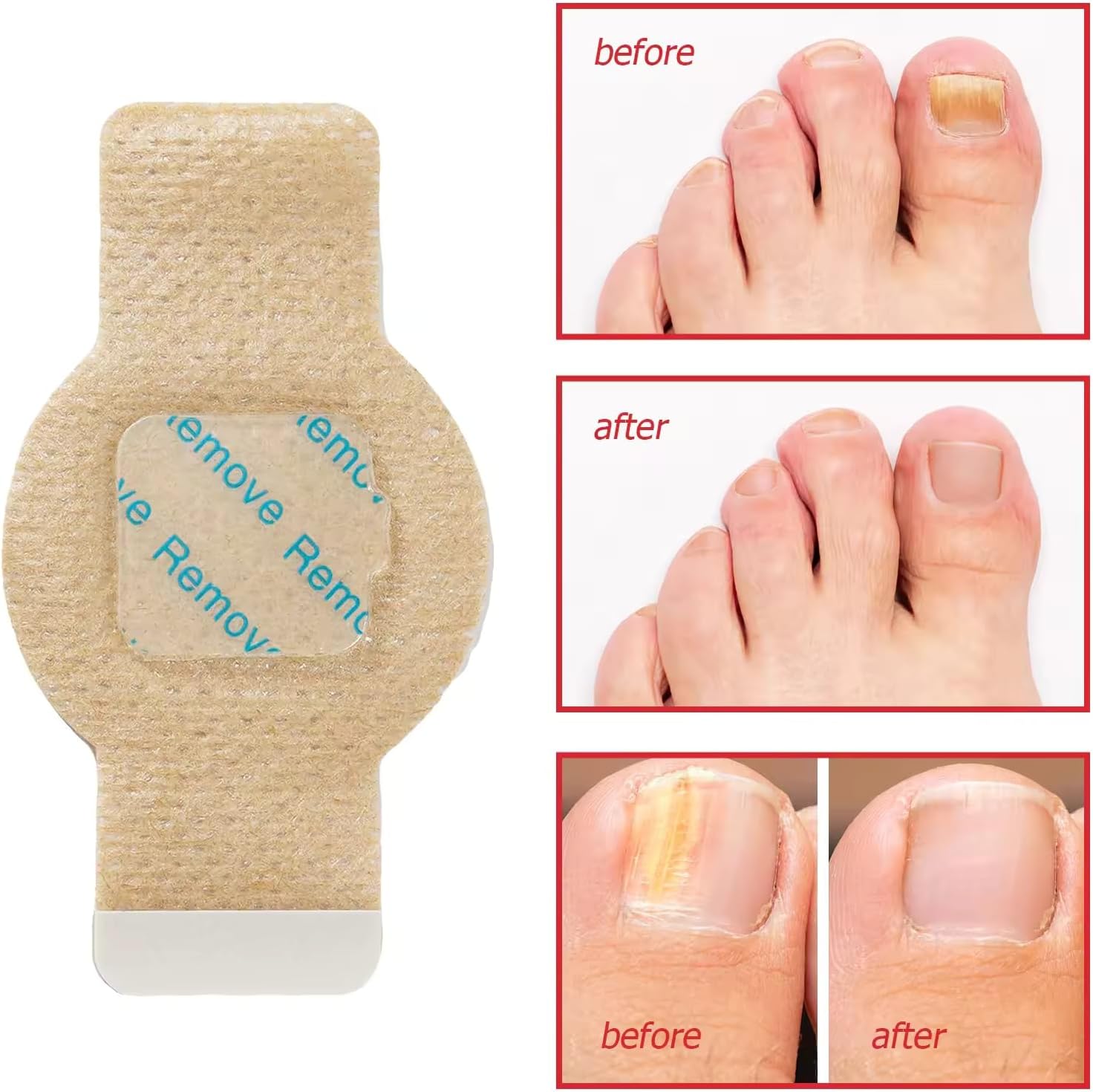 Nighttime Renewal Fungal Nail Patches (Pack of 21)